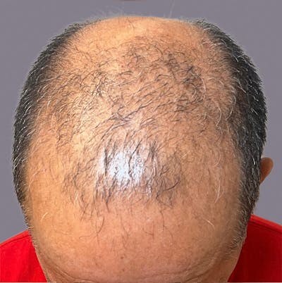 PRP for Hair Loss Before & After Gallery - Patient 221780 - Image 2