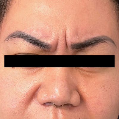 BOTOX Before & After Gallery - Patient 372775 - Image 1