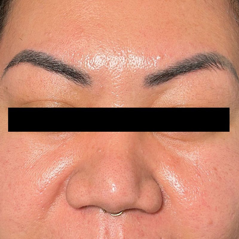 BOTOX Before & After Gallery - Patient 372775 - Image 2