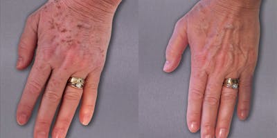 Lumecca IPL Before & After Gallery - Patient 341816 - Image 1