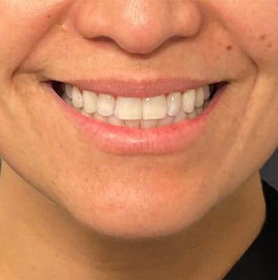 Fillers Before & After Gallery - Patient 953903 - Image 1