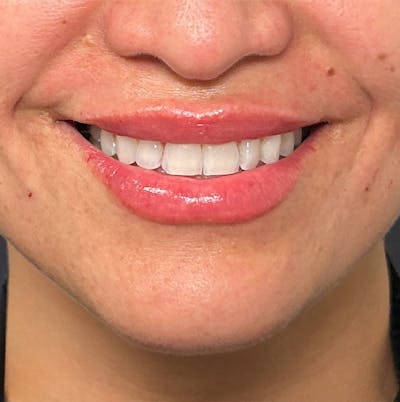 Fillers Before & After Gallery - Patient 953903 - Image 2