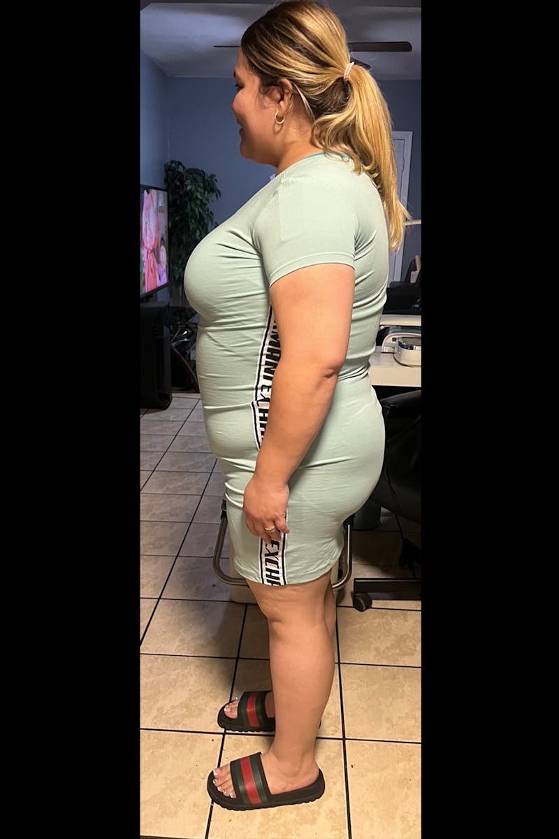 Weight Loss Before & After Gallery - Patient 233189 - Image 2