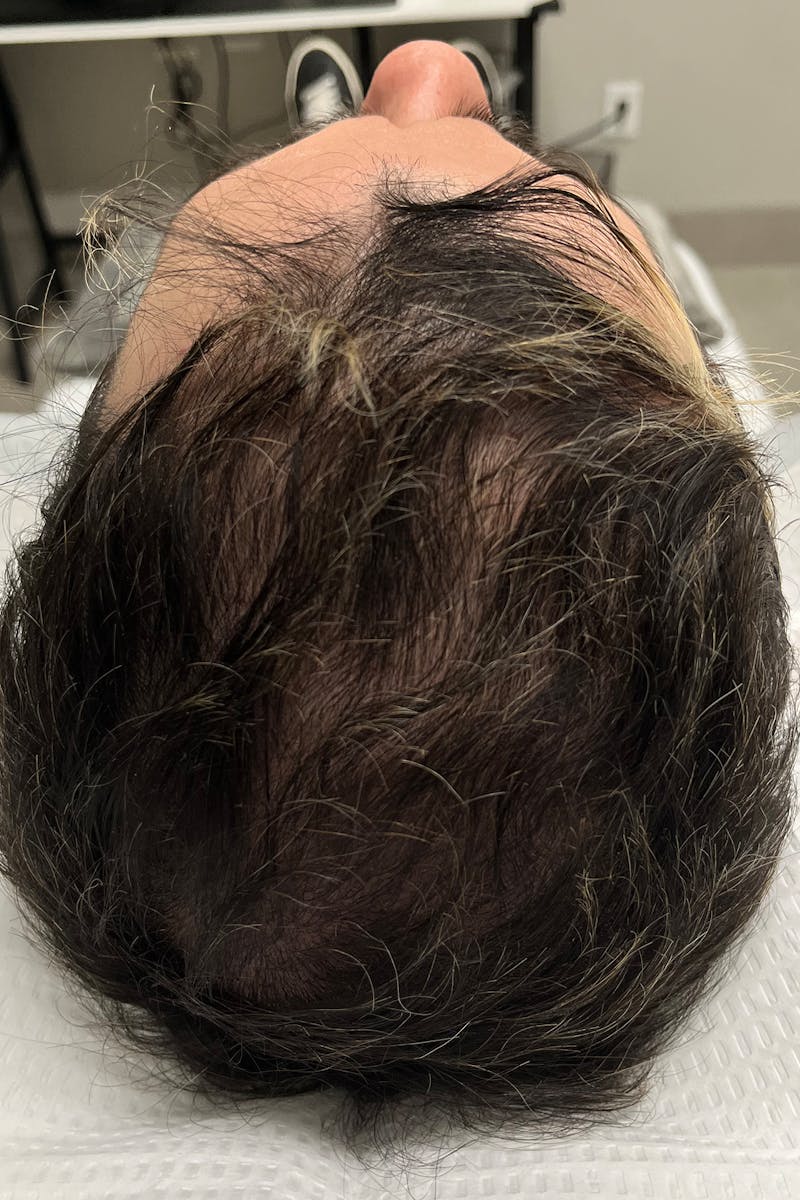 PRP for Hair Loss Before & After Gallery - Patient 105017 - Image 2