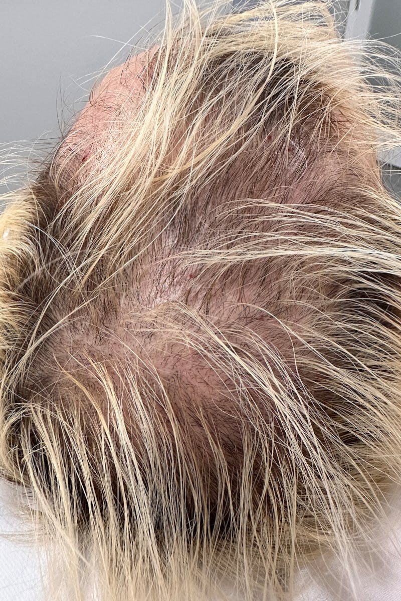 PRP for Hair Loss Before & After Gallery - Patient 105017 - Image 1