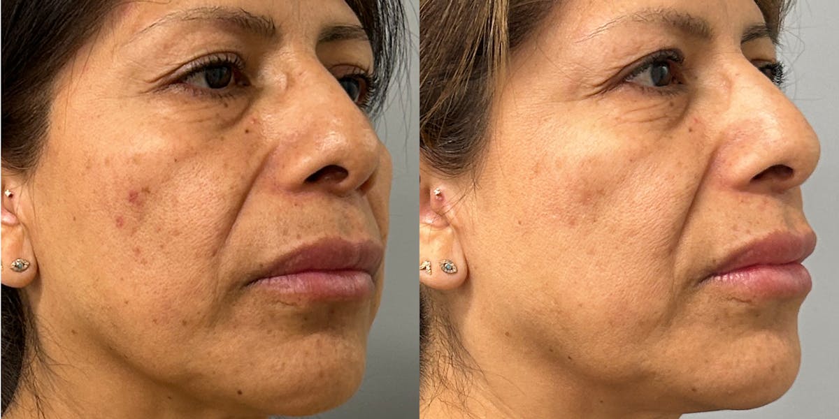 Lumecca IPL Before & After Gallery - Patient 320239 - Image 1