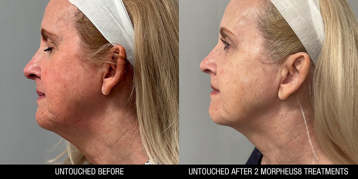 Morpheus 8 Before & After Gallery - Patient 334000 - Image 3