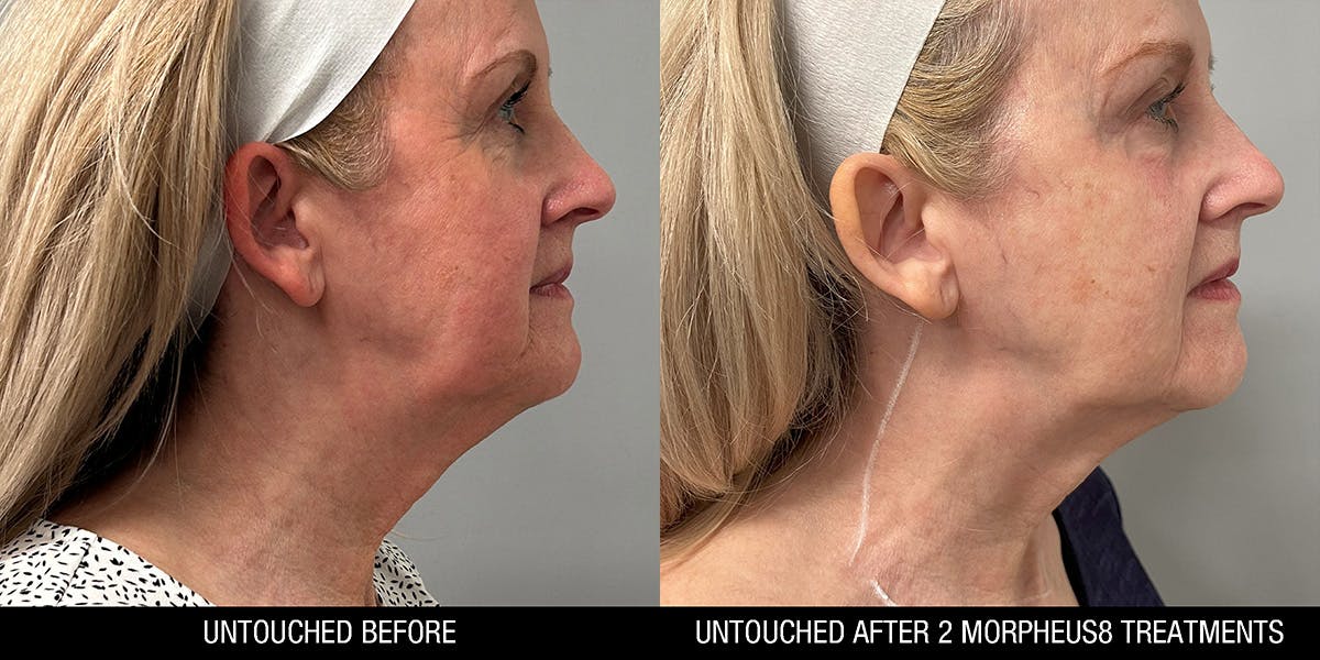 Morpheus 8 Before & After Gallery - Patient 334000 - Image 2