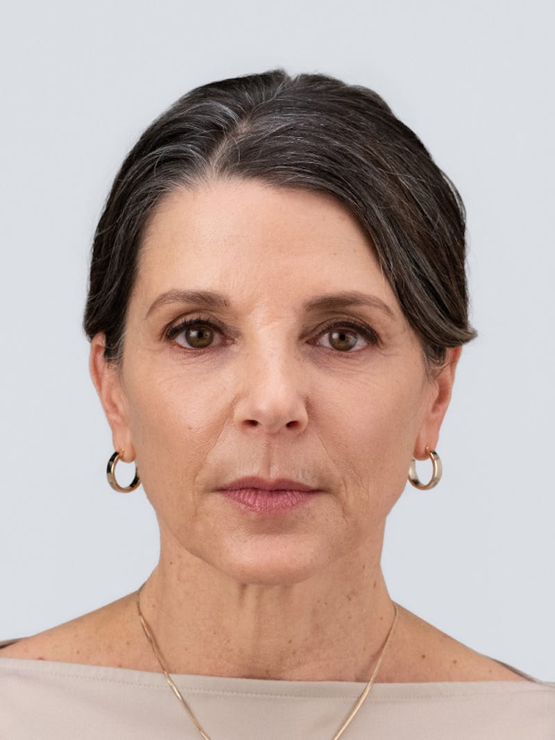 RHA Collection Before & After Gallery - Patient 233757 - Image 1