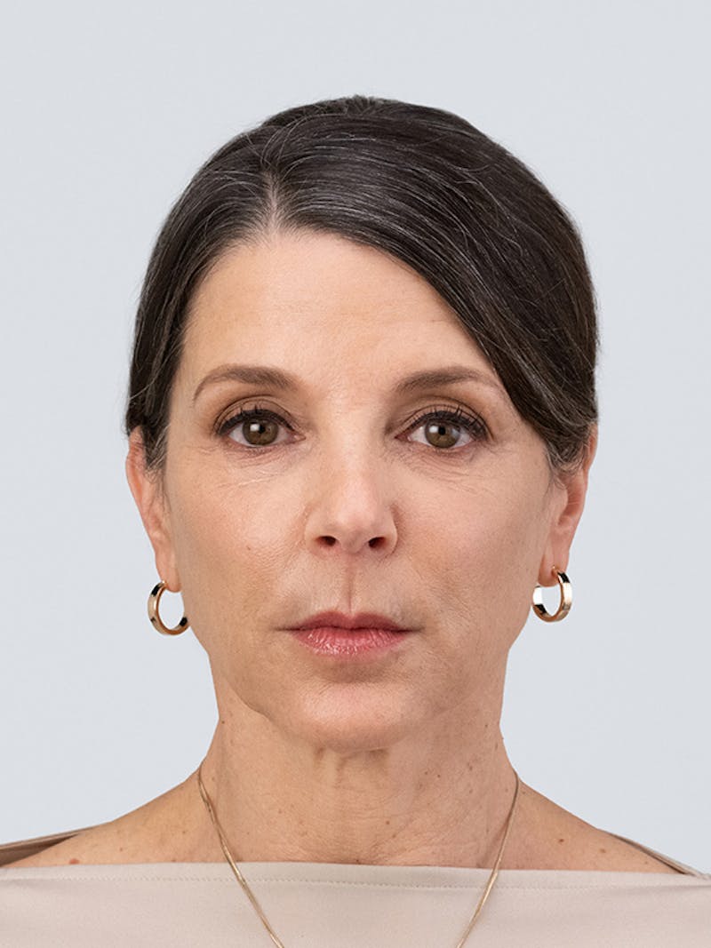 RHA Collection Before & After Gallery - Patient 233757 - Image 2