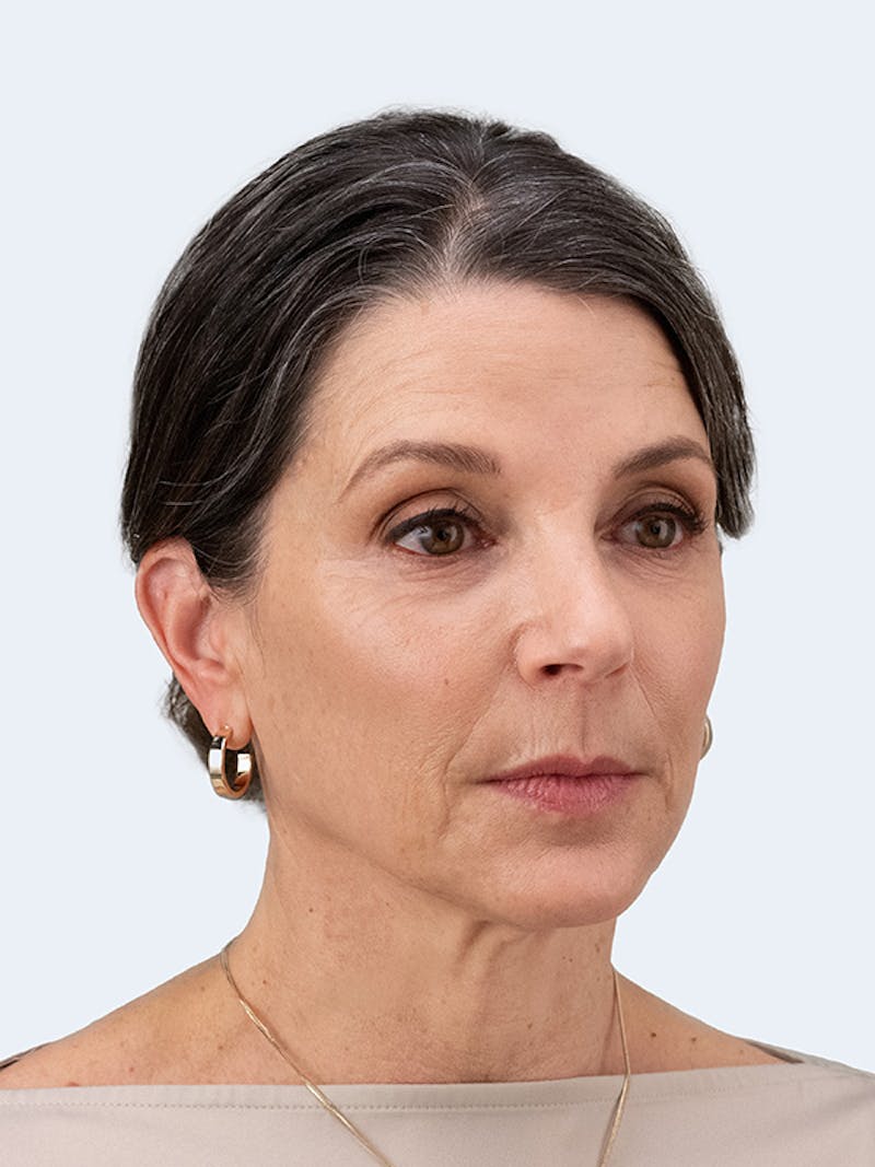 RHA Collection Before & After Gallery - Patient 233757 - Image 9