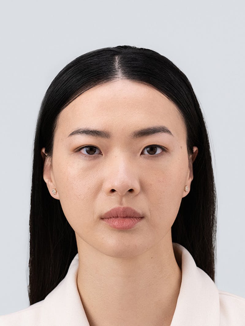 RHA Collection Before & After Gallery - Patient 340547 - Image 3