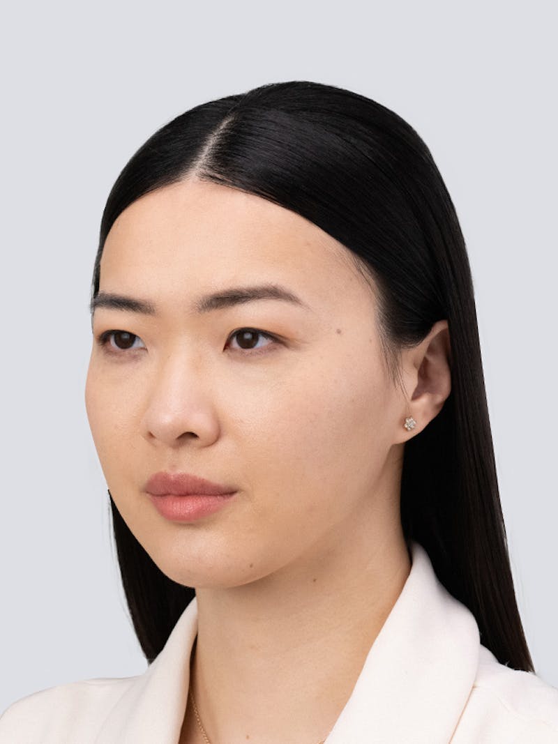 RHA Collection Before & After Gallery - Patient 340547 - Image 10
