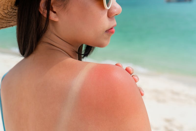 woman with sunburn