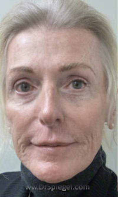 Non-Surgical Feminization Before & After Gallery - Patient 155005223 - Image 1