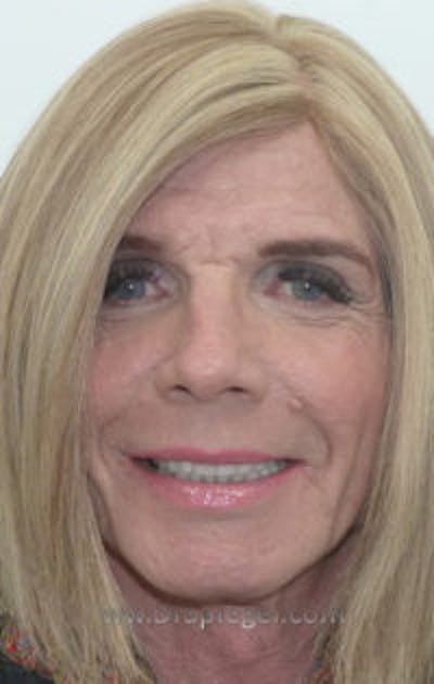 Non-Surgical Feminization Before & After Gallery - Patient 155005225 - Image 1