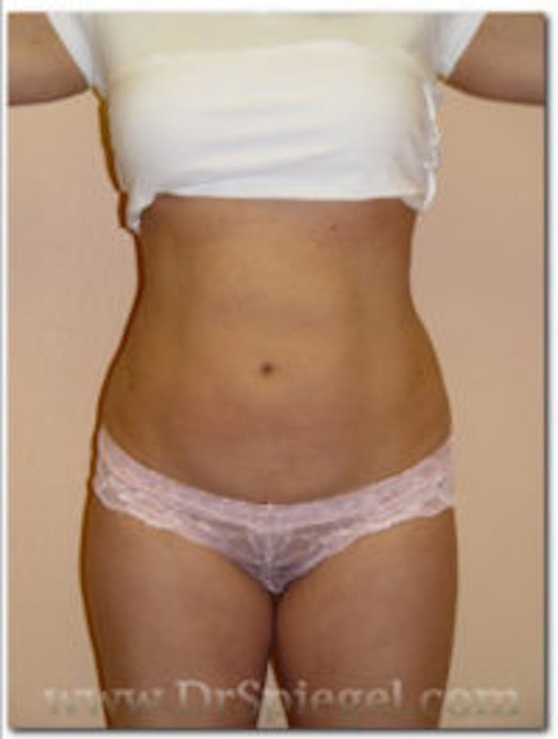 Mommy Makeover Before & After Gallery - Patient 155395600 - Image 2