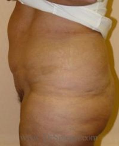Mommy Makeover Before & After Gallery - Patient 155395607 - Image 1