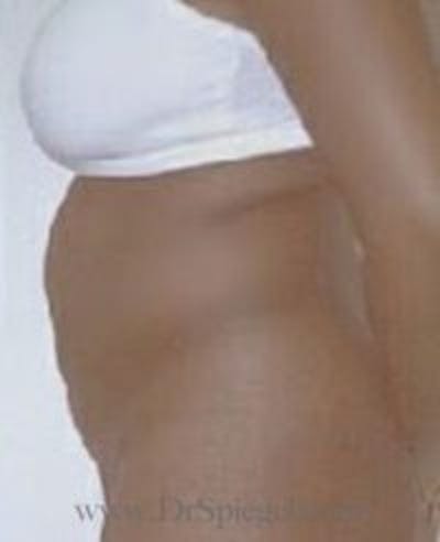Mommy Makeover Before & After Gallery - Patient 155395609 - Image 1