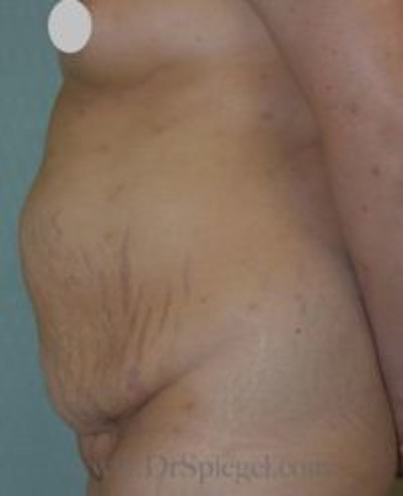 Mommy Makeover Before & After Gallery - Patient 155395631 - Image 1