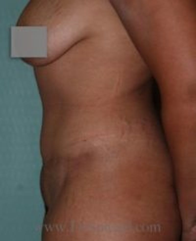 Mommy Makeover Before & After Gallery - Patient 155395651 - Image 2