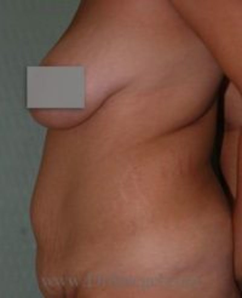 Mommy Makeover Before & After Gallery - Patient 155395655 - Image 1