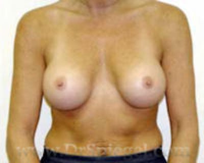 Mommy Makeover Before & After Gallery - Patient 155395721 - Image 2