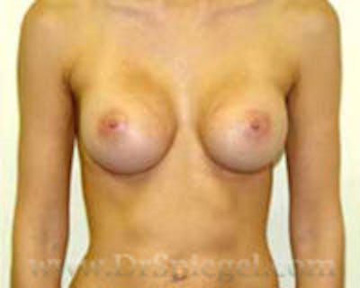 Mommy Makeover Before & After Gallery - Patient 155395738 - Image 2