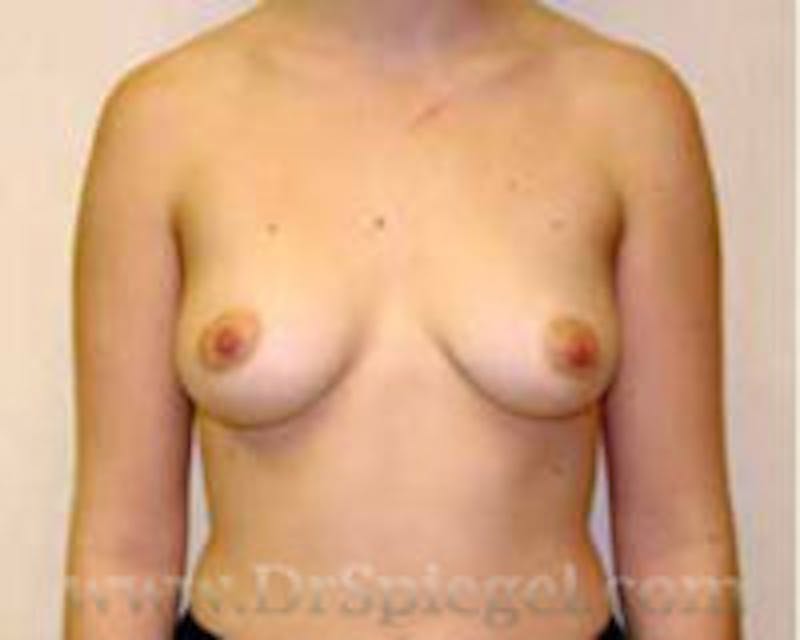 Mommy Makeover Before & After Gallery - Patient 155395752 - Image 1