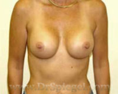 Mommy Makeover Before & After Gallery - Patient 155395756 - Image 2