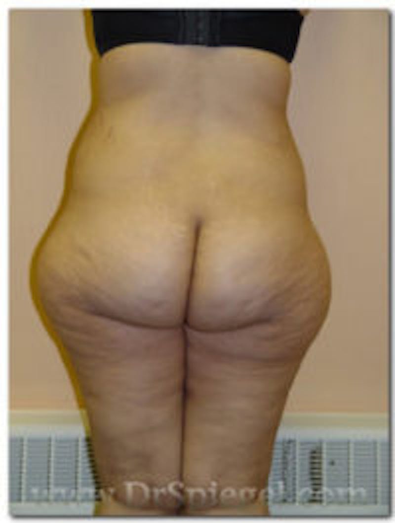 Mommy Makeover Before & After Gallery - Patient 155395762 - Image 1
