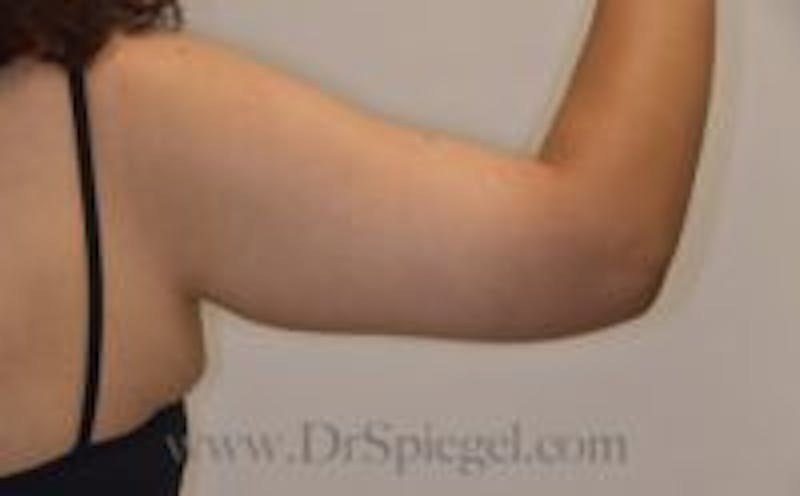 Mommy Makeover Before & After Gallery - Patient 155395770 - Image 2