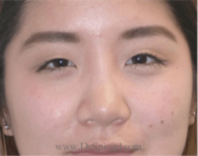 Monolid/Double Eyelid Surgery Before & After Gallery - Patient 157563567 - Image 1