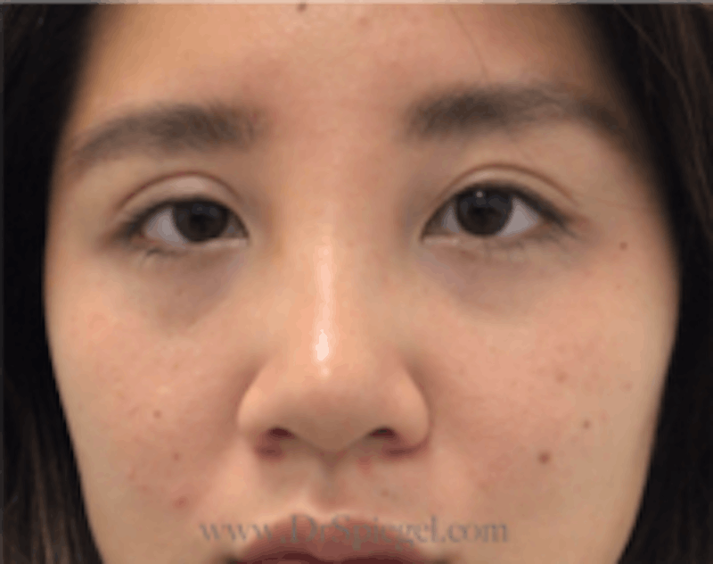 Monolid/Double Eyelid Surgery Before & After Gallery - Patient 157563567 - Image 2