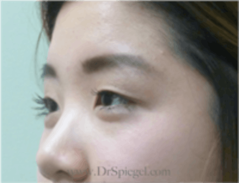 Monolid/Double Eyelid Surgery Before & After Gallery - Patient 157563567 - Image 3