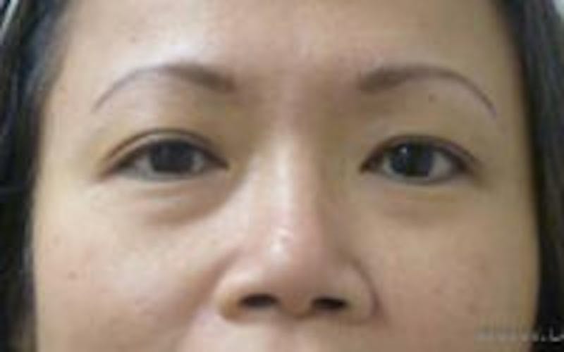 Monolid/Double Eyelid Surgery Before & After Gallery - Patient 157563568 - Image 1