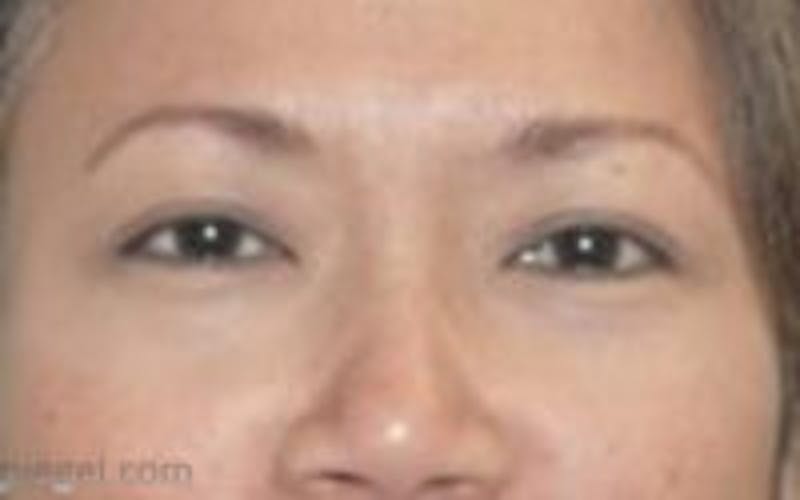 Monolid/Double Eyelid Surgery Before & After Gallery - Patient 157563568 - Image 2