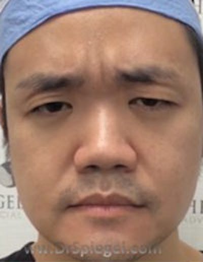 BOTOX/Dysport/Jeuveau/Xeomin Before & After Gallery - Patient 157563529 - Image 1