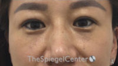 Tear Trough Filler Before & After Gallery - Patient 157563448 - Image 1