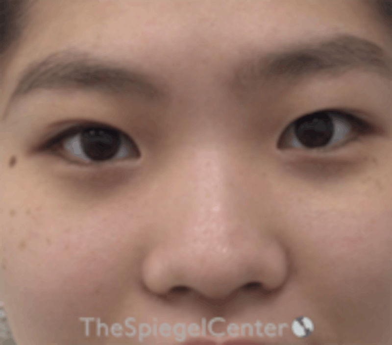 Non-Surgical Rhinoplasty Before & After Gallery - Patient 157563284 - Image 1