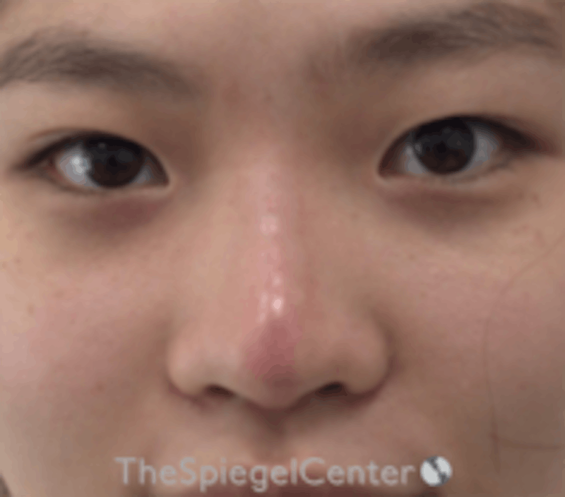 Non-Surgical Rhinoplasty Before & After Gallery - Patient 157563284 - Image 2