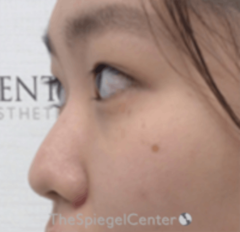 Non-Surgical Rhinoplasty Before & After Gallery - Patient 157563284 - Image 3