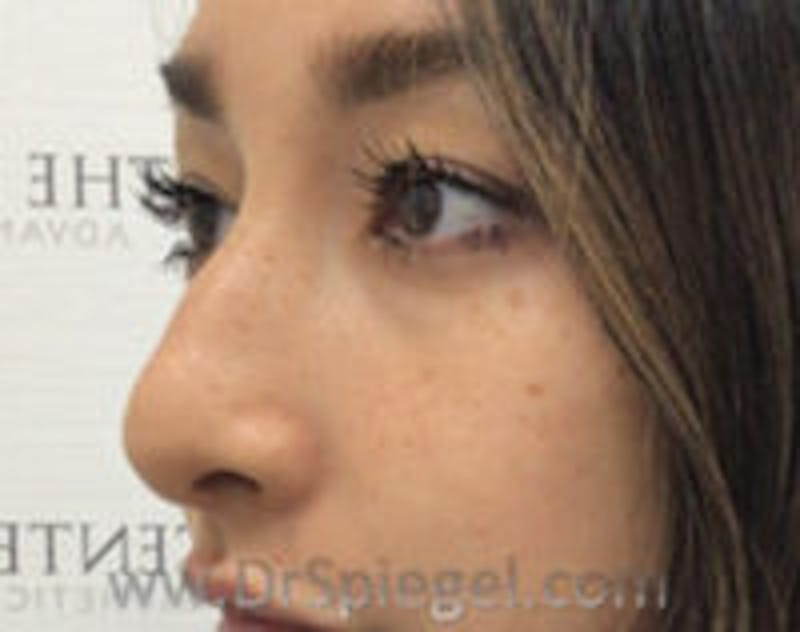 Non-Surgical Rhinoplasty Before & After Gallery - Patient 157563286 - Image 3