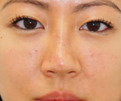 Non-Surgical Rhinoplasty Before & After Gallery - Patient 157563290 - Image 1
