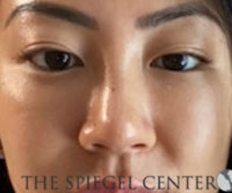 Non-Surgical Rhinoplasty Before & After Gallery - Patient 157563290 - Image 2