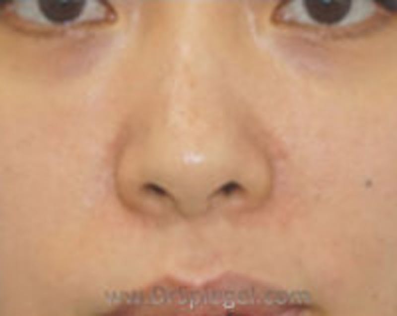Non-Surgical Rhinoplasty Before & After Gallery - Patient 157563292 - Image 2
