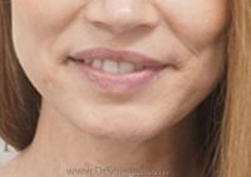 Mandible Contouring Before & After Gallery - Patient 157563152 - Image 2