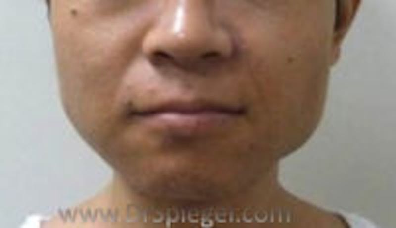 Mandible Contouring Before & After Gallery - Patient 157563154 - Image 1