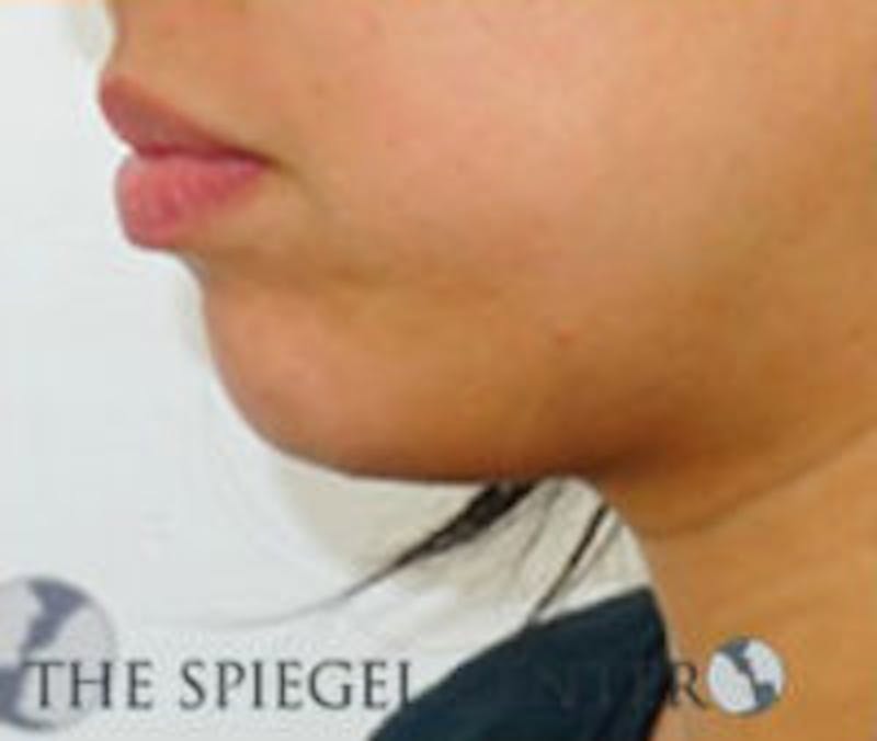 Chin Filler Before & After Gallery - Patient 157563029 - Image 3
