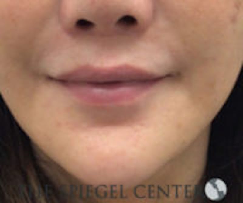 Lip Filler Before & After Gallery - Patient 157563001 - Image 1